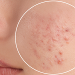 Lamelle skincare expert answers the most common questions about acne