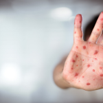 Measles – it’s a serious illness