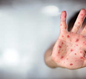 Measles – it’s a serious illness