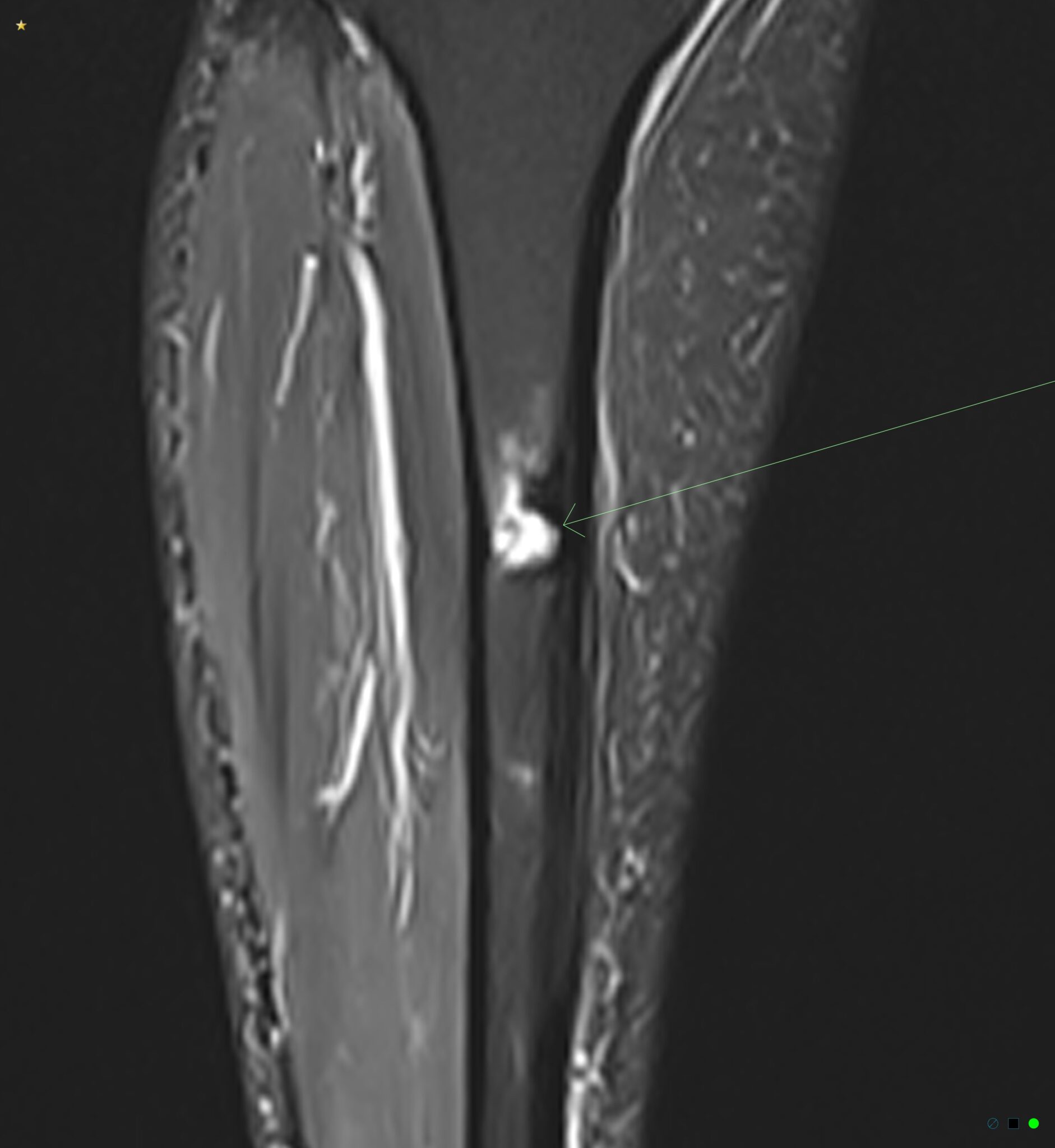 Mri Leg Performance Understanding sports injuries: The role of radiology in diagnosis and ...